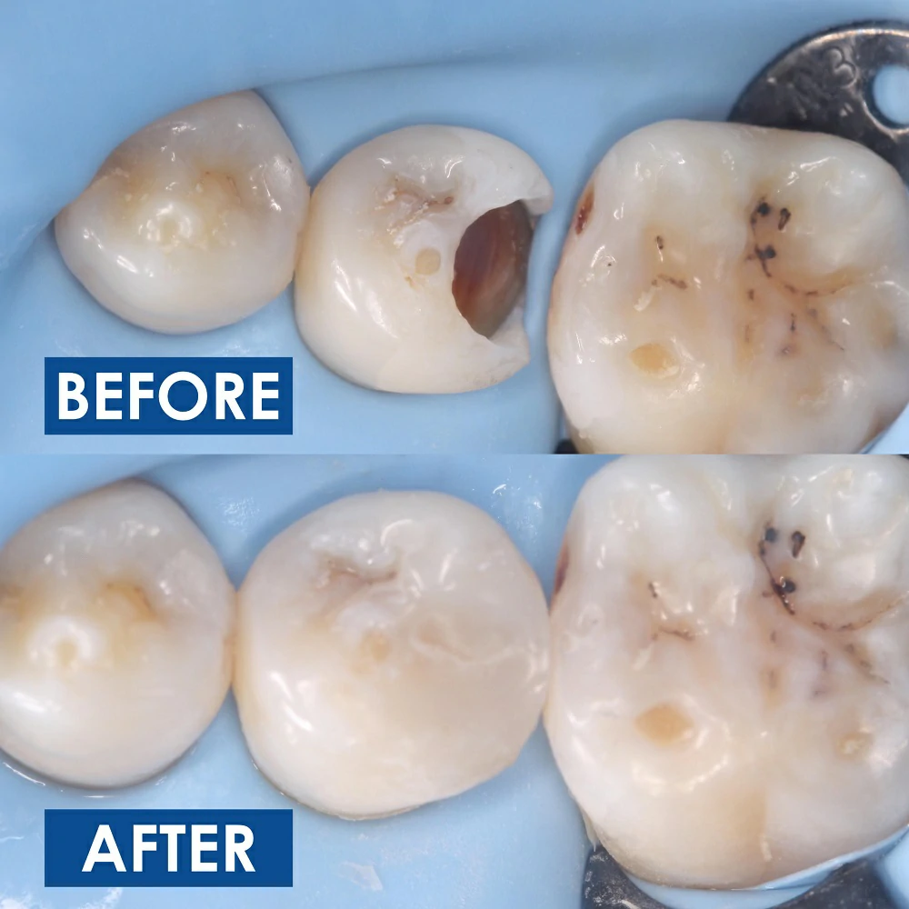 Fillings
