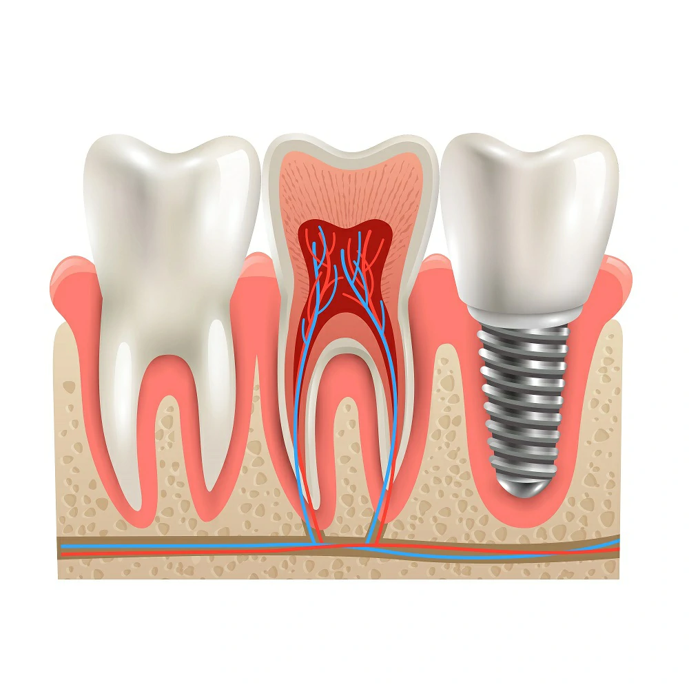 Implant